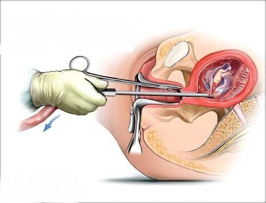 Медицинский аборт 