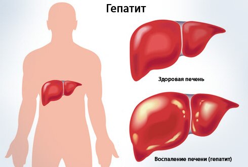 Гепатит В