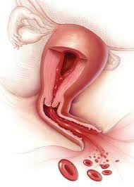 Коррекция менструального цикла при ановуляторных маточных кровотечениях 