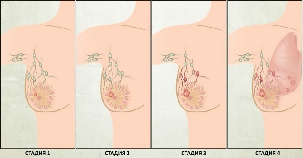 рак груди, стадии рака груди