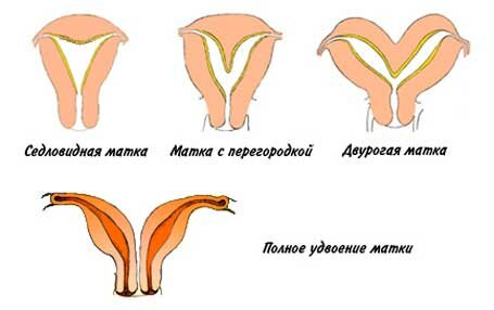 Пороки развития матки и маточных труб