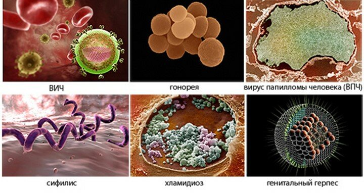 ЗППП, ИППП, половые инфекции, инфекции передающиеся половым путем, венерические болезни, венерические инфекции