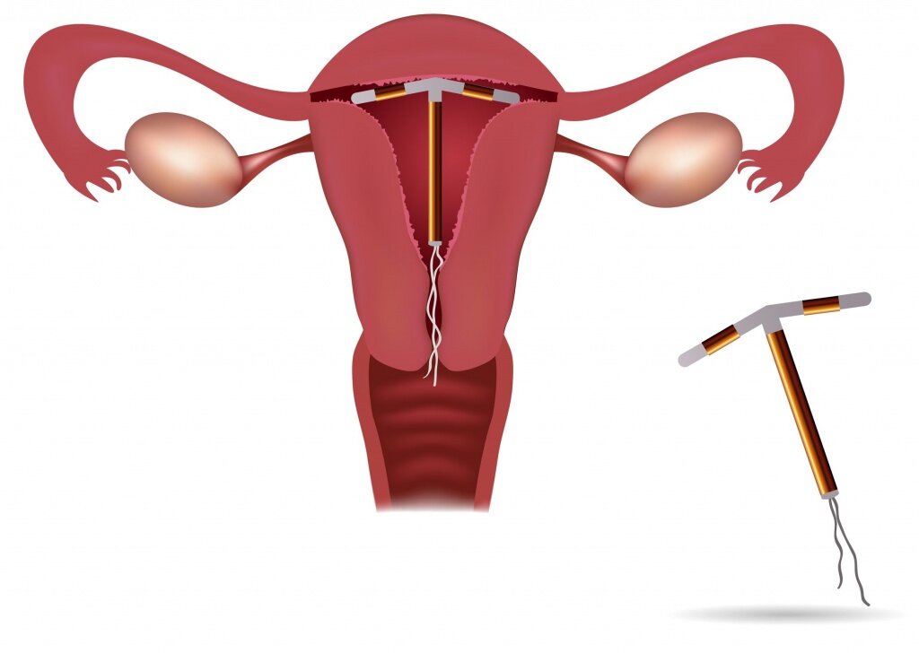 Внутриматочная контрацепция, внутриматочная спираль, спираль предохранение
